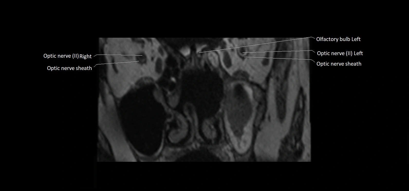Cranial nerve cross sectional anatomy coronal 3T MRI image 2.webp